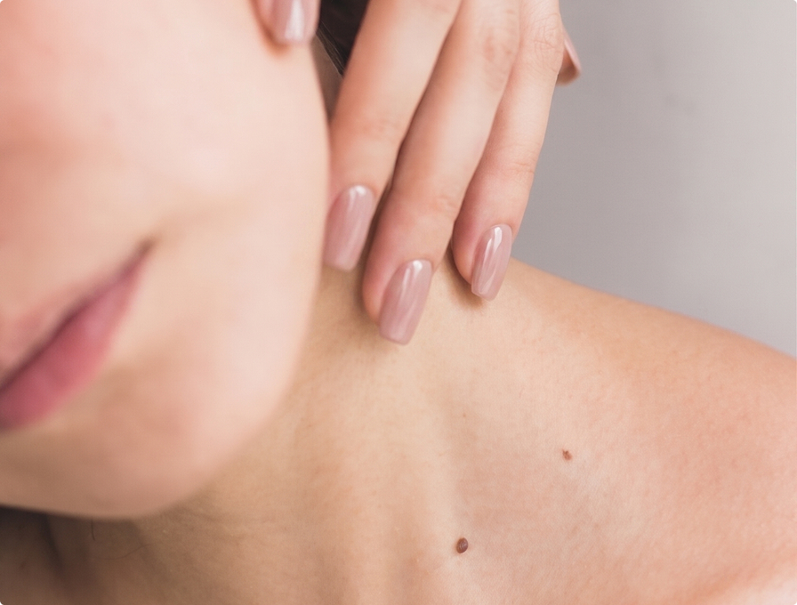 Skin Tag Removal