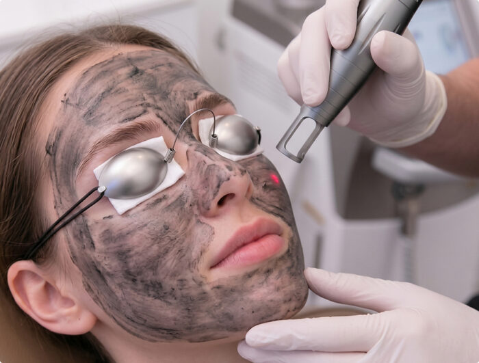 Spectra Hollywood Laser Peel