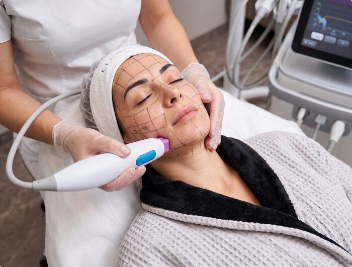 Thermage Skin Tightening