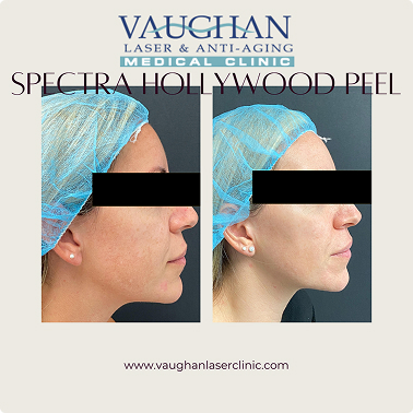 Spectra Hollywood Laser Peel