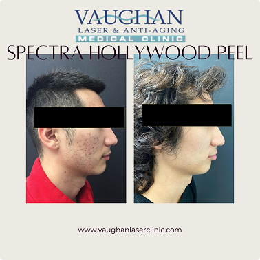 Spectra Hollywood Laser Peel